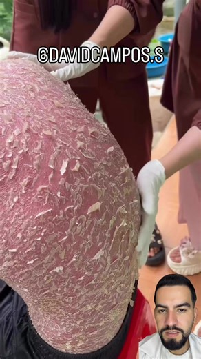 Piel descamando #ictiosislaminar #drdavidcampos