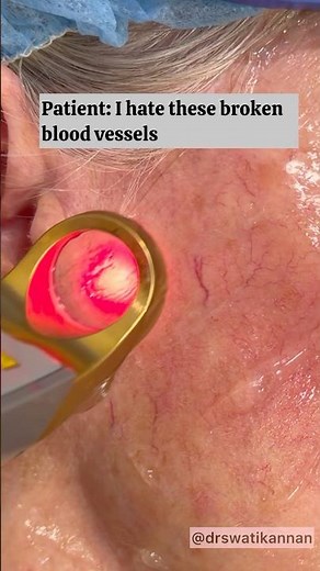 Get Rid of Broken Blood Vessels 🪄