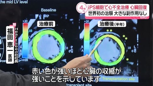 iPS細胞で心不全治療　心臓の機能が回復　大きな副作用なし…世界初の治験（日テレNEWS NNN）