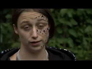 Meisje krijgt 56 sterretjes op gezicht