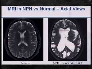 Normal Pressure Hydrocephalus Explained