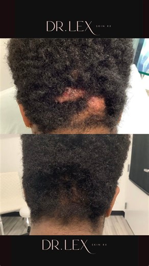 Skincare Tips with Dr. Alexis on Instagram: "Acne Keloidalis Nuchae (AKN) is not razor bumps, barber’s rash, or acne. It’s a chronic inflammatory condition that can develop into large, keloid-like plaques on the scalp and neck. Early diagnosis and proper treatment by a dermatologist are key. In advanced cases, surgical removal can restore confidence and the hairline. Expertise matters. 👩🏾‍⚕️✨ #akn #dermsurgery #hairrestoration #scalphealth #acnekeloidalisnuchae #razorbumps #keloidtreatment"