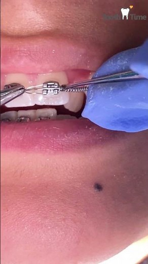 What are open coil springs? #dentist #braces