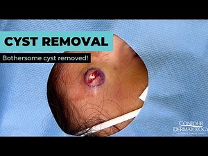 How Do Dermatologists Remove Cysts? | CONTOUR DERMATOLOGY