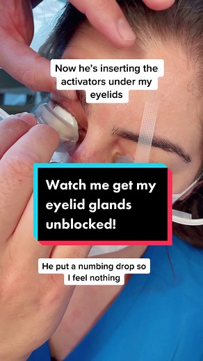 You asked, I delivered! Here’s the treatment that unblocks the oil glands in the eyelid #lipiflow #dryeyedisease #howtotreatdryeyes #thermalpulsation #eyedropshop