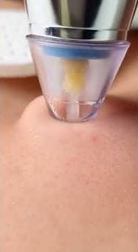 The Most Satisfying Pore Cleaning Video You'll Watch Today