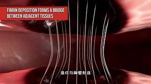 肺手术后为什么会导致胸腔黏连，3D演示。。