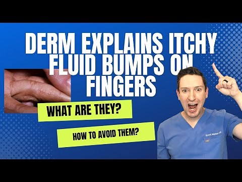 Do you have ITCHY, FLUID, LITTLE BUMPS on your HANDS OR FEET? Derm explains Dyshidrotic Eczema