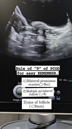 76K views · 801 reactions | PCOD #sonographiccasestudy #education #ultrasound #radiology #reelsvideoシ #reelsfyp | Sonographic case study | Facebook