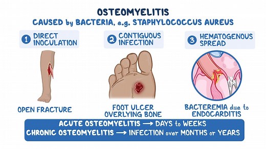 Video: Osteomyelitis: Clinical sciences - Video Explanation! | Osmosis | Osmosis