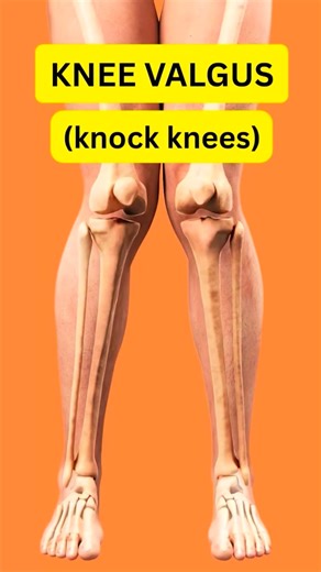 Genu valgum, commonly called “knock-knee”, is a condition in which the knees angle in and touch each other when the legs are straightened. Individuals with severe valgus deformities are typically unable to touch their feet together while simultaneously straightening the legs.#physiotherapy #knockknee #jaunpur #rehabilitation #doctor #pain #reels #kneepainrelief | Pradeep Maurya