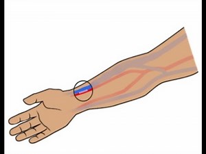Assessment of AV Fistula maturation and first-time needling | English