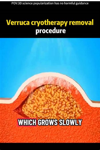 How Warts Are Removed (3D Animation)#medical3danimation #3dmedicalanimation #warts #wartsremoval #dermatologist
