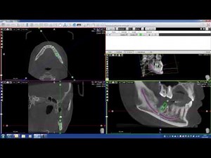 Implant PLanning with Acteon Imaging Suite CBCT Cone Beam