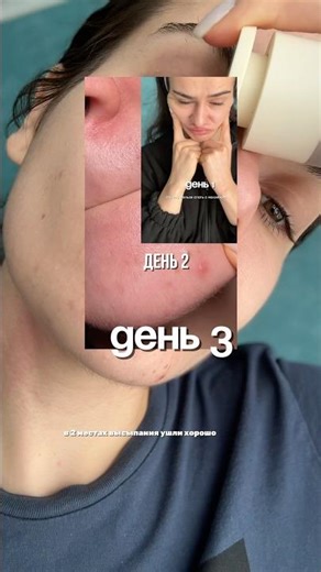 #WW124644 - sos средство 🤌🏻#бьюти #прыщи #уходоваякосметика #салициловакислота | РП