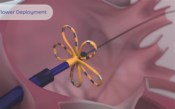 脉冲场消融（Pulse Field Ablation, PFA）