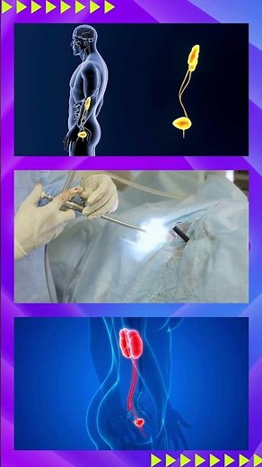 A visual journey through nephrectomy: Our video simplifies the complexities of this surgery.