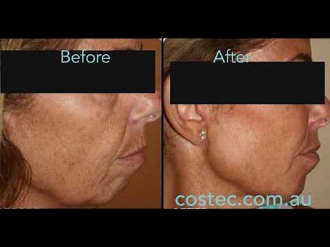 HIFU™ treatment - Before & After pictures for Face Lift and Skin Tightening