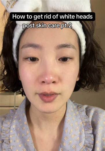 Effective Strategies to Eliminate Whiteheads