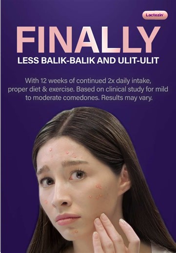 Lactezin: Effective Acne Treatment for Clearer Skin