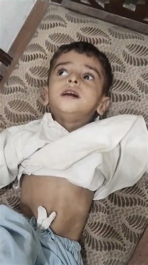 Kernicterus Child Neurological disorder | Approch with Plumbum Met | #shorts #neuroscience