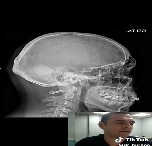 Understanding Osteoma Craneal and Its Diagnosis