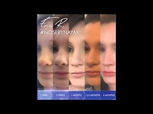 Healing After Rhinoplasty: The Real Story