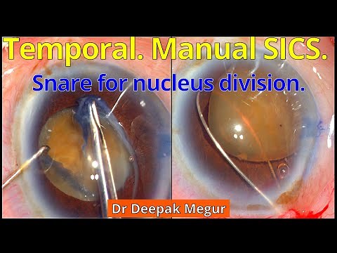 Manual SICS and minimal Surgical Induced Astigmatism - Dr Deepak Megur