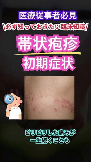 必ず知っておきたい医療知識！帯状疱疹の初期症状⚠️ #帯状疱疹 #帯状疱疹後神経痛 #神経痛 #看護師 #介護士 #医療従事者 #看護師の日常 #薬剤師 #リハビリ