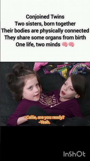 Conjoined Twins – Two Sisters Born Connected | Rare Human Case