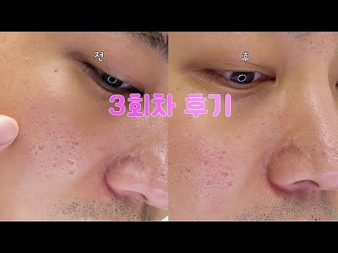 포텐자 쥬베룩 효과기록 포텐자 레이저 후기 [3회차]