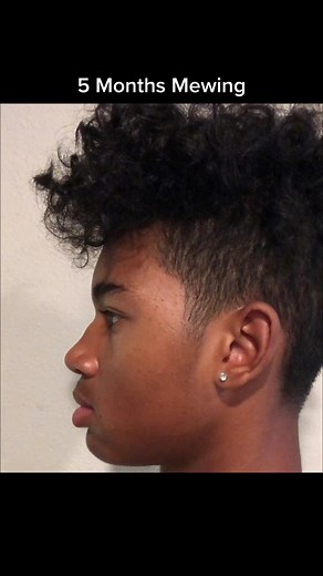 5 Months Mewing Transformation | Does Mewing Work?