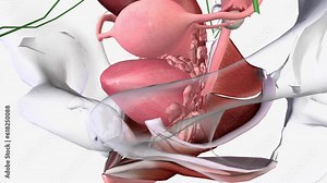 Cervical Cancer Stage 4 means the cancer has spread to the bladder or back passage (rectum) or further away Stock Video