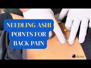 This Is How Master Acupuncturists Assess Chronic Back Pain with acupuncture
