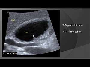 Adenomyomatosis of gallbladder