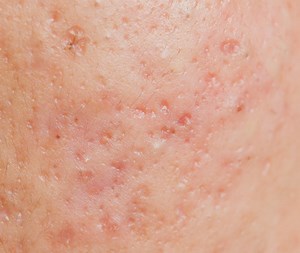 Boxcar Scars - acne support