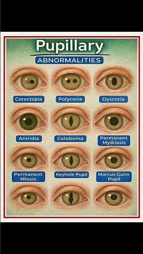 👁️ Pupillary Abnormalities Explained in Seconds | Eye Health Facts #Shorts