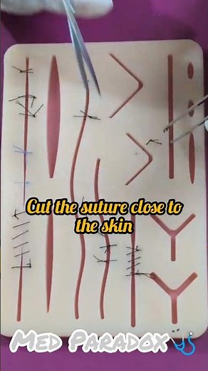 how to remove a suture safely? Step-by-step tutorial