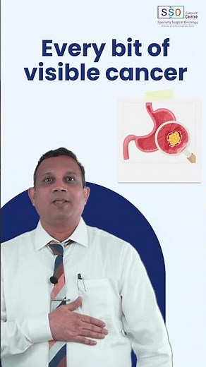 Cytoreductive Surgery: When Is It Recommended?