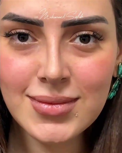 Two weeks post-procedure ✨Natural harmony. Normal breathing. 👃🏼