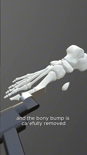 New Natural Bunion Fix – With Shark Screw® #bunion #sharkscrew #halluxvalgus
