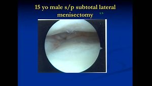 Meniscus Repair, Substitution, and Transplantation