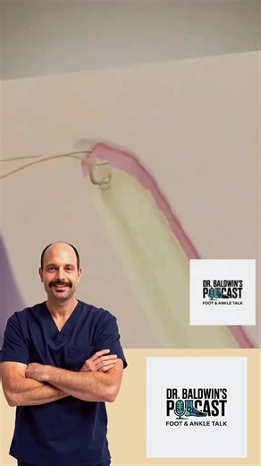 Ever wondered what dissolvable stitches actually are? 👀 This animation breaks down a continuous running suture—from burying the knot deep in the dermis to smoothly bringing the skin edges together and hiding everything beneath the surface. No epidermis stitching. No visible knots. Just clean technique and a beautifully finished closure. Perfect for students, clinicians, and anyone curious about how wounds really heal 🧵✨ #dissolvablestitches #sutures #medicaleducation #medtok #surgerytok