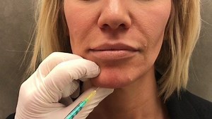 The mentalis muscle of the chin is an important area to treat with Botox. The majority of the patients Matt Kelleher, MD treats with Botox is the mentalis. It allows the chin to “relax” and both smooth and lengthen. #wrinkles #botox | Premier Dermatology