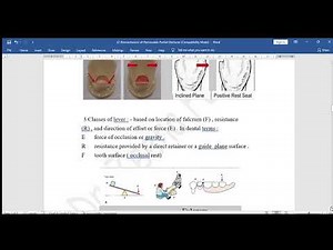 Biomechanics of Removable Partial Dentures