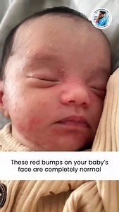 38K views · 15 reactions | Worried about red bumps on your baby’s...