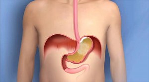 36K views · 249 reactions | Many people experience mild acid reflux from time to time, but chronic, more severe cases could be the mark of Gastroesophageal Reflux Disease, or GERD. It's caused by stomach acid splashing into the esophagus repeatedly. Learn more about GERD and Mayo Clinic's approach to care. https://mayocl.in/2Gp23Ko | Mayo Clinic | Facebook