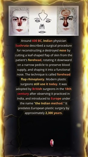 The Sushruta's Forehead Rhinoplasty Method