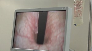 Bladder from the inside