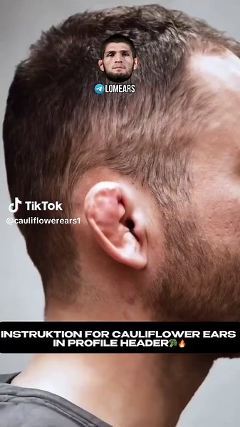 How to Manage Cauliflower Ears: Complete Guide